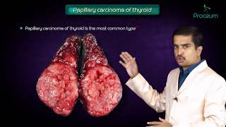 Thyroid neoplasms part 1  Papillary carcinoma of thyroid   Endocrine pathology [upl. by Urian]