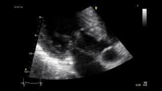 HYPERTROPHIC CARDIOMYOPATHY ECHOCARDIOGRAM  SAM [upl. by Trebloc]