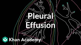 What is a pleural effusion  Respiratory system diseases  NCLEXRN  Khan Academy [upl. by Tanhya782]