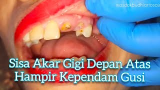 Dua Akar Gigi Depan Atas Hampir Kependam Gusi Suka Bikin Gusi Jerawatan Akhirnya Dicbt [upl. by Gentilis]