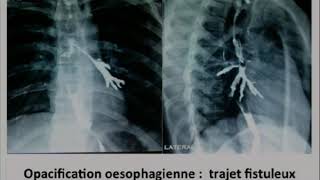 Traitement chirurgical d’une fistule œsotrachéale posttraumatique [upl. by Aissert]