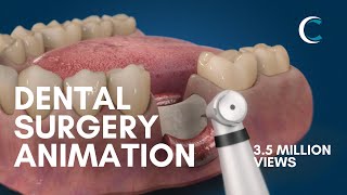 Dental Surgery Animation  Bone Grafting [upl. by Atiluap]