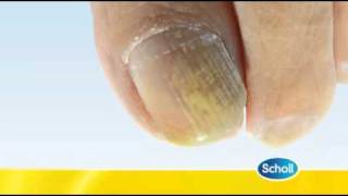 Fungal Nail Condition by Scholl [upl. by Ysteb]