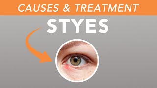 The Truth About Styes [upl. by Karlene]