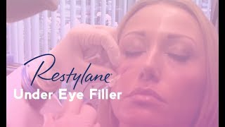 Restylane Under Eye Filler  Total Dermatology [upl. by Annaeg]