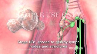 Lung Cancer Staging NonSmall Cell [upl. by Iturk]