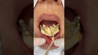 전체임플란트 수술당일임시치아 dental dentist implantdentist implantdentistry [upl. by Esir]