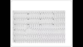 Fascicular VT  Dr Akif Baig [upl. by Yanahs]