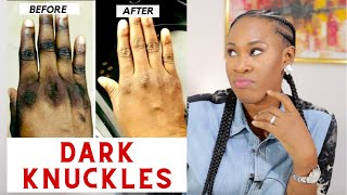 How to use Lemon Clear Lemonvate cream for dark spotsdark knuckles and skin lightening [upl. by Aiveneg]