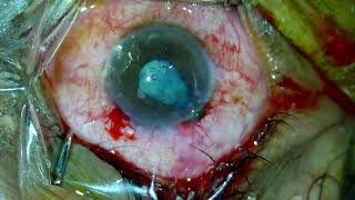 Corneal laceration Repair Traumatic cataract phaco [upl. by Tcideneb338]