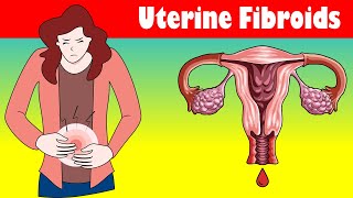 Uterine Fibroids Signs And Symptoms Types Causes And Treatment [upl. by Howlend850]