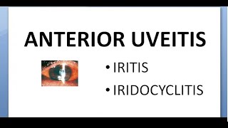 Ophthalmology 162 Anterior Uveitis Iritis IridoCyclitis Non suppurative glaucoma mechanism treatment [upl. by Oliviero]