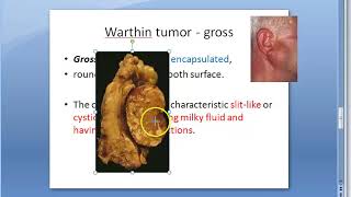 Pathology 533 a Warthin Parotid Salivary Gland Papillary cystadenoma lymphomatosum microscopy [upl. by Oberon388]