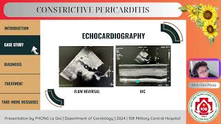 Constrictive pericarditis [upl. by Salguod]