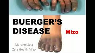 Buergers disease  Mizo [upl. by Menard]