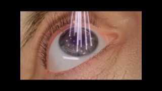 LASIK 100 laser  étape de photoablationwmv [upl. by Root]