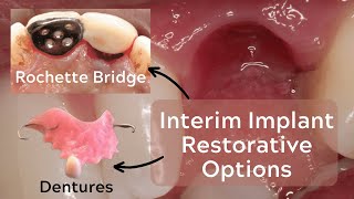 Rochette Bridges and Provisional Prostheses for Implants – PDP145 [upl. by Hahnke]