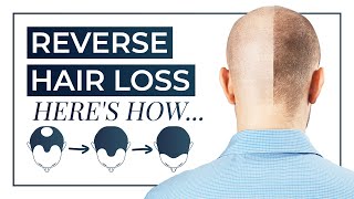 How To Reverse Hair Loss  Treatment DHT Blocking Shampoo Medication [upl. by Nnahsal]