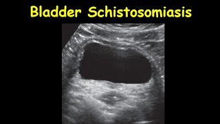 Bladder Schistosomiasis [upl. by Okihcim702]