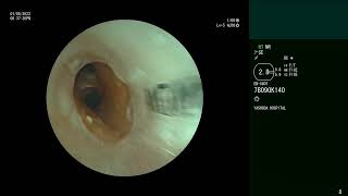 Bronchoscopic closure of Bronchopleural Fistula  Silicone Y stent [upl. by Hum]