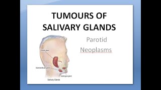 ENT Tumors of Salivary Glands Parotid Neoplasms Benign Malignant Pleomorphic Warthin Cylindroma [upl. by Jaynes871]