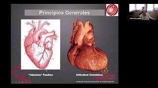 EXTRASÍSTOLES VENTRICULARES LOCALIZACIÓN MEDIANTE ECG DE SUPERFICIE PREPARANDO LA ABLACIÓN [upl. by Ayrad82]