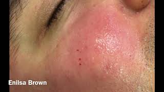 Christians Acne Treatment  Blackheads Extractions [upl. by Enyamert831]