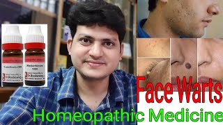 How to remove Warts on Your face by Homeopathic Medicine [upl. by Dias]