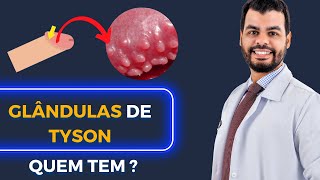 Quem tem Glândulas de Tyson Veja o vídeo com Dr Marcell Lins Melo  Urologista [upl. by Adnulahs702]