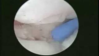 Arthroscopic View of Distal Radius Articular Fracture  Dr Alejandro Badia [upl. by Ettari171]