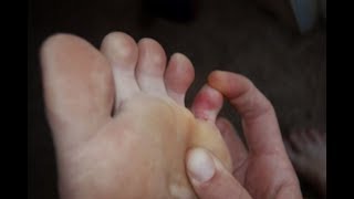 Pinky 5th Toe Pain  Best Home Treatment Guide [upl. by Lever]