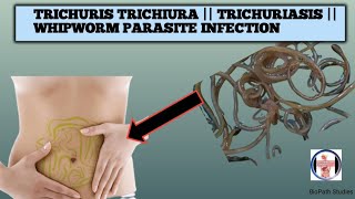 Know about Trichuris Trichiura TrichuriasisWhipworm parasite infection its lifecycle pathogenesis [upl. by Kimberlee]