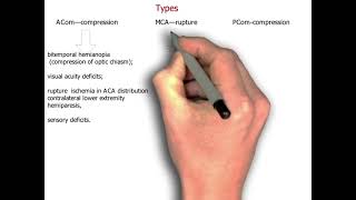 Aneurysm  Saccular Aneurysm  neurology 87  First Aid USMLE Step 1 in UrduHindi [upl. by Jehu]