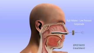 Epistaxis Treatment  3D [upl. by Llenyl]