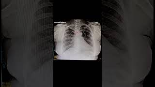 Cardiomegaly Cardiomegaly Heart X ray chest shortvideo [upl. by Enoob598]