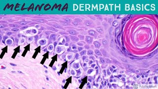 Melanoma vs Nevus Microscopic Clues for Malignancy Explained in 5 Minutes [upl. by Waiter]