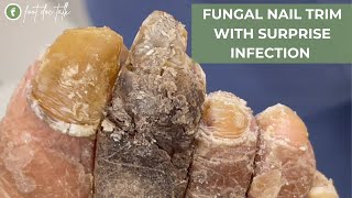 FUNGAL NAIL TRIM WITH SURPRISE INFECTION PART 1 [upl. by Pooi]