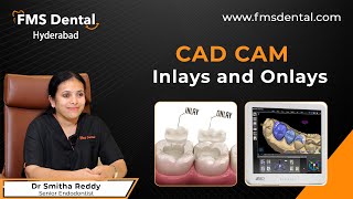 CADCAM Inlays and Onlays by Dr Smitha Reddy  FMS Dental [upl. by Norrej]