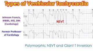 Types of Ventricular Tachycardia [upl. by Melessa]