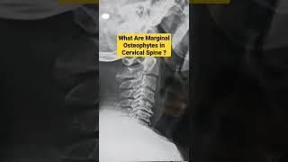 What Are Marginal Osteophytes in Cervical Spine  Dr Sai Chandra Orthopaedic Surgeon In Hyderabad [upl. by Nnahaid]