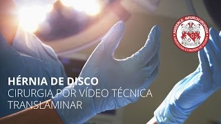 Cirurgia de Hérnia de disco por Vídeo Técnica Translaminar  Dr Diogo Neurocirurgião [upl. by Larok]