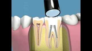 Tutti i passaggi della terapia canalare e della capsula dentale [upl. by Echikson]