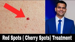 Red Skin Dots  cherry Angioma  Natural Treatment  Dr Vivek Joshi [upl. by Ellenwad]