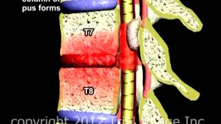 Spinal Infection video  Animation by Cal Shipley MD Trial Image Inc [upl. by Yanel]