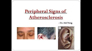 Peripheral signs of atherosclerosis  Dr Akif Baig [upl. by Haldes]