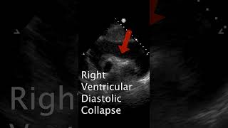 Signs of Pericardial Tamponade POCUS ultrasound emergencymedicinecardiology criticalcare [upl. by Nivlek678]