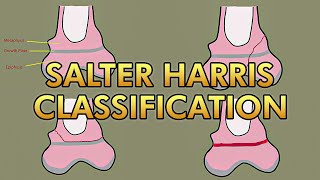 Salter Harris Classification for Pediatric Growth Plate Fractures [upl. by Goddart]