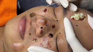 blackheads new 2023  popping pimple today  blackheads and whiteheads removal [upl. by Sirenay]