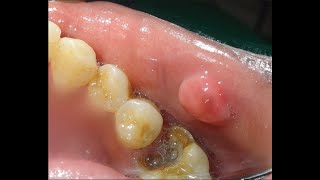 Hyperplastic amp Neoplastic lesions of oral cavity Part 1 [upl. by Ruprecht]