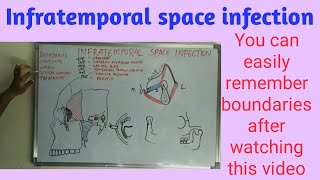 Infratemporal space infection [upl. by Eleanor]